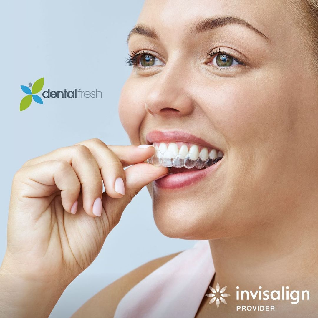 Clear aligners