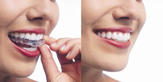 Cosmetic Dentistry in Bondi by Dental Fresh Experts